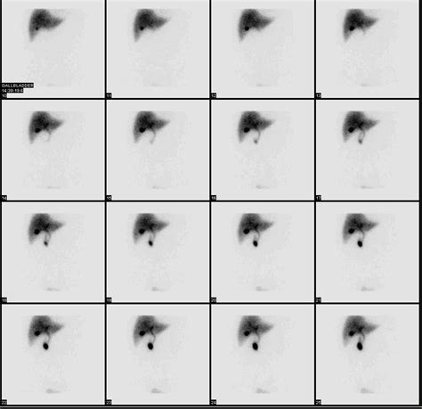 Cholescintigraphy .